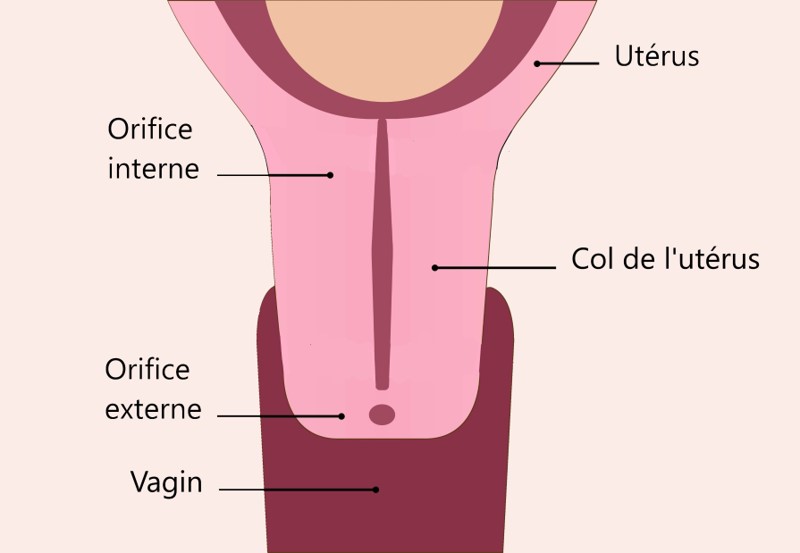Cerclage définitif du col de l'utérus (cerclage de Benson)