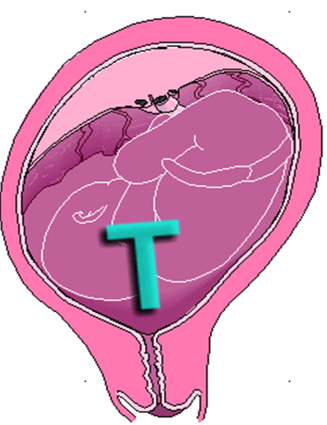 Ouverture du col en T