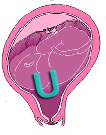 Ouverture du col en U