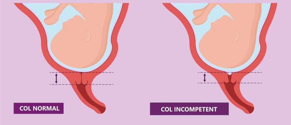 Raccourcissement / effacement rapide du col